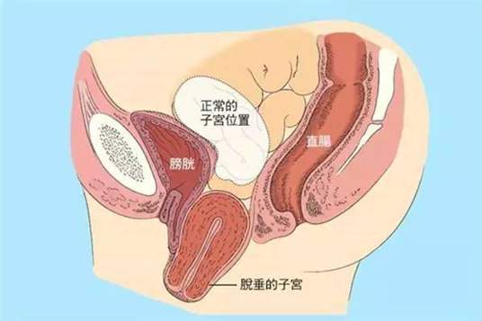 子宫脱垂位置图