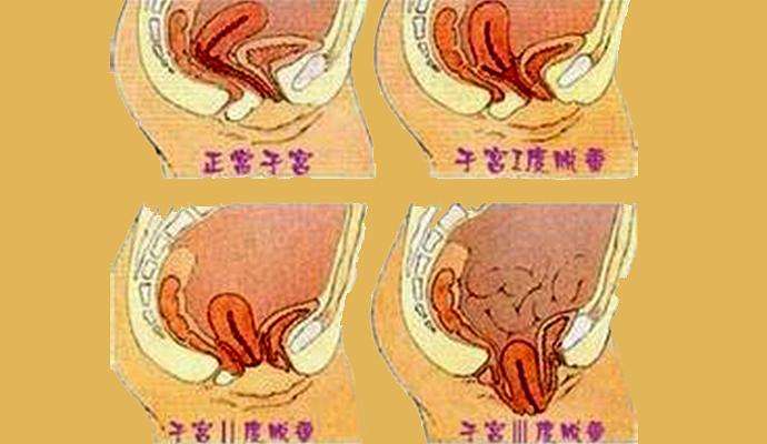 子宫脱垂根据程度不同