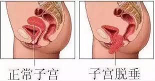 产后子宫脱垂的症状与治疗有哪些