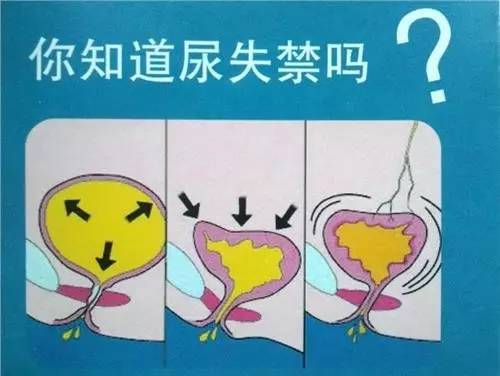 女人漏尿尿失禁怎么好呀