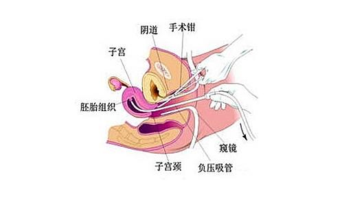做无痛人流有生命危险吗